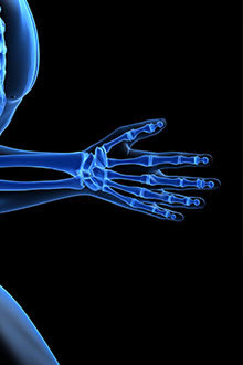 carpal tunnel syndrome